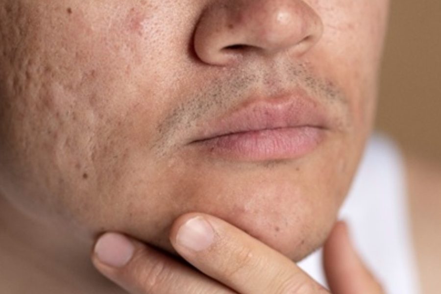 Dermatologista explica o que são e como lidar com as cicatrizes na pele