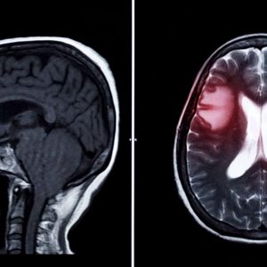 Você tem 3% de chance de ter um aneurisma cerebral sem saber