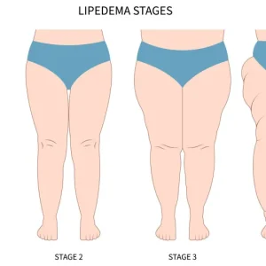 Lipedema é hereditário? Especialista responde as dúvidas sobre a condição