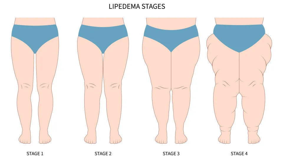 Lipedema é hereditário? Especialista responde as dúvidas sobre a condição