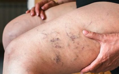 Má circulação sanguínea? Eis o treino ideal para o sistema linfático