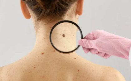 Câncer: estudo alerta para riscos de melanoma fora da pele